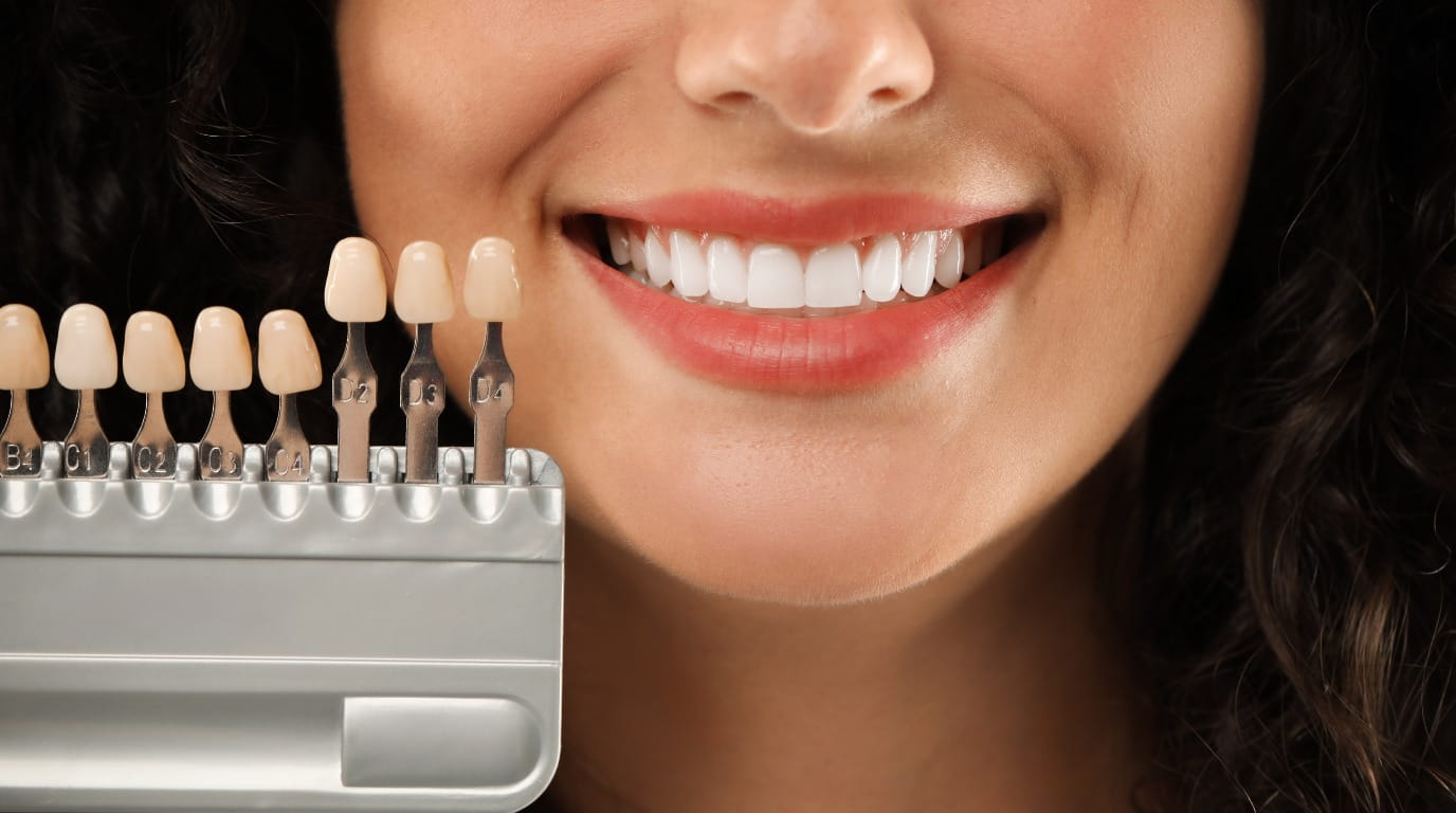 porcelain dental veneers for smile makeover in Dubai
